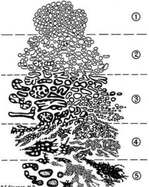 Figura  3  -  Classificação  de  Gleason.  Os  diferentes  graus  (1-5)  estão  associados  a  diferentes  padrões  histopatológicos