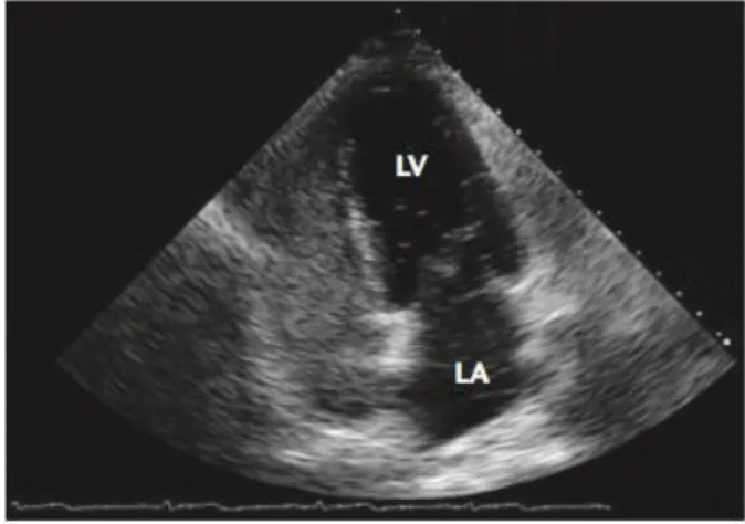 Figura 3: Identificação do FOP através do ETT com injeção de contraste. As câmaras cardíacas direitas  encontram-se completamente opacificadas pelo  contraste, e estão presentes tanto na  AE como no VE  microbolhas