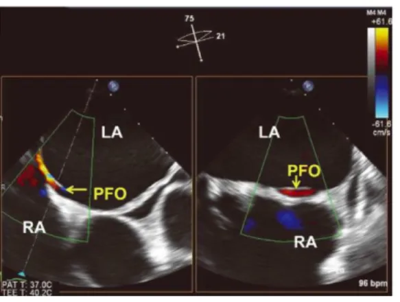 Figura  5:  ETE  com  doppler  colorido,  onde  se  visualiza  um  shunt  direita  esquerda  através  do  FOP