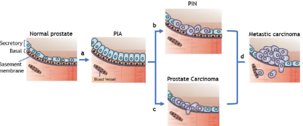 Figure 2c and d) [3,10,34]. Changes of epithelial and stromal cells genes expression during the  different development stages of PCa notably contribute to the enhancement of tumor growth,  survival, migration, and invasiveness [3,35]