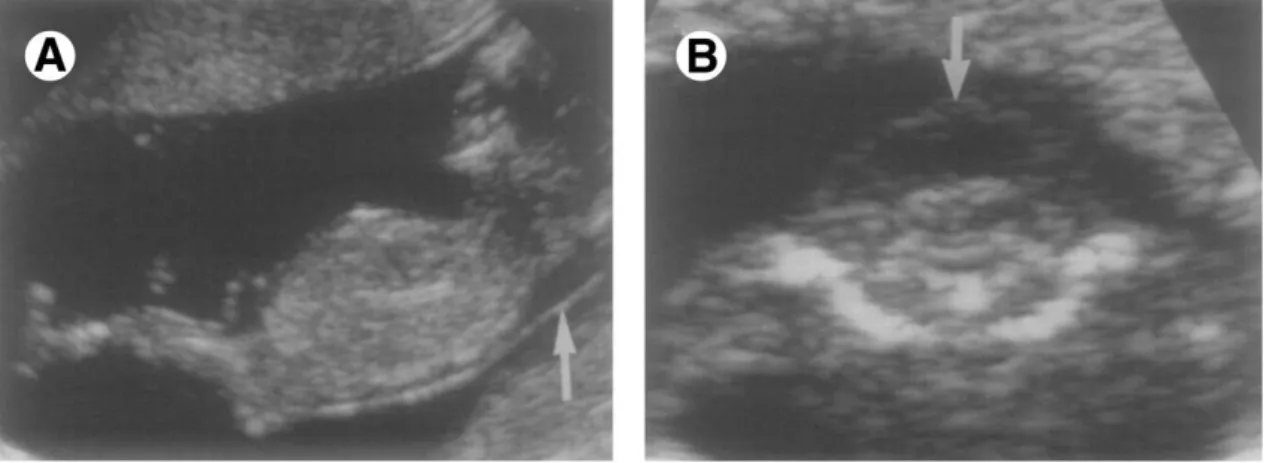 Figura 8: Higroma Cístico. (A) Vista sagital do feto em que a seta aponta para a espessura aumentada da  translucência da nuca
