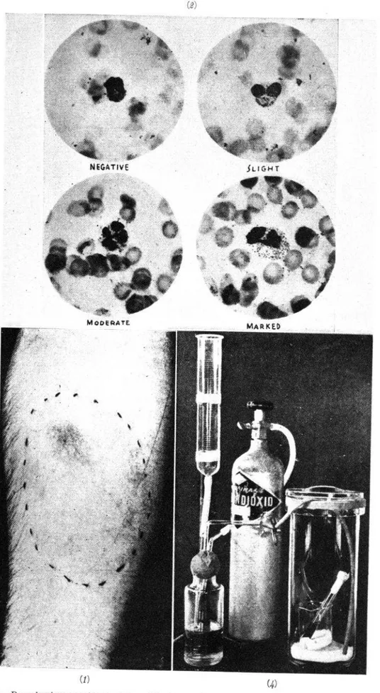 FIG.  I.-Brucelerginorreacción  positiva,  Obsérvese  el  extenso  edema. 