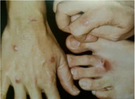 Fig. 2. Múltiplas pápulas e nódulos eritematosos no dorso das mãos e dos pés de um casal