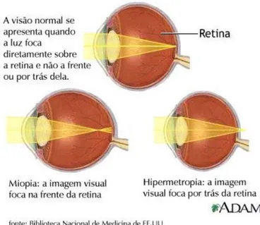 Figura 1. Ametropias (http://www.opticaview.com.br/dicas/miopia_arquivos/image001.jpg)