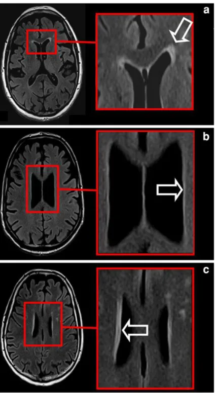 Fig.  1  –  Sinal  hiperintenso  da  região  periventricular  da  substância  branca  detetado  em  sequência  FLAIR na imagem por RM