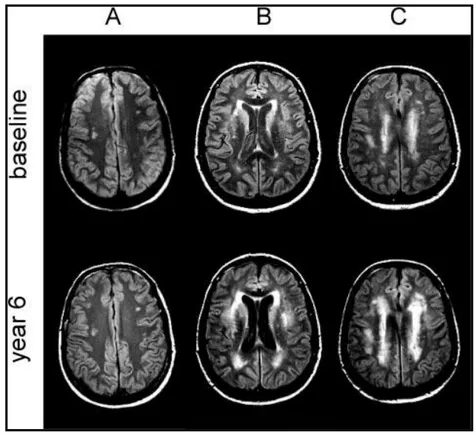 Fig.  6-  Imagens  por  RM  no  início  do  estudo  e  após  6  anos  de  seguimento  de  3  participantes  no  Austrian Stroke Prevention Study