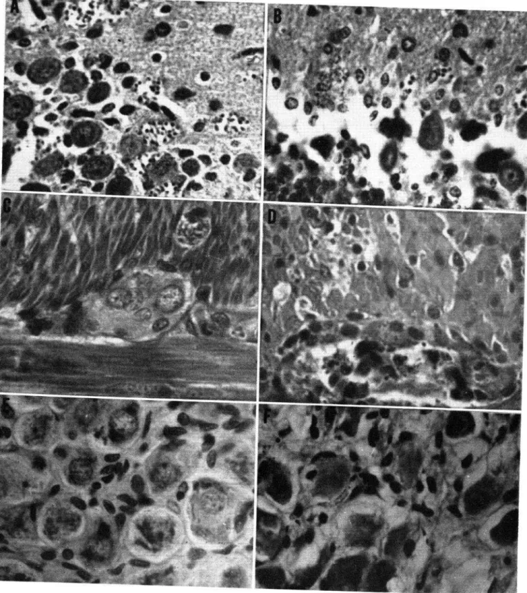 FIG.  3.-Lesiones  degenerativas  de  las  neuronas  (infección  experimental  en  ratas-fase  aguda)