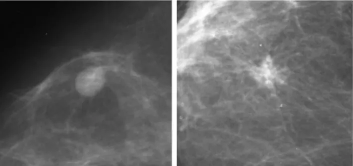 Fig. 1. Example of benign lesion on the left and malign lesion on the right.