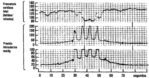 FIGURA  l-Pujos  espontáneos  por  contracción  uterina. 