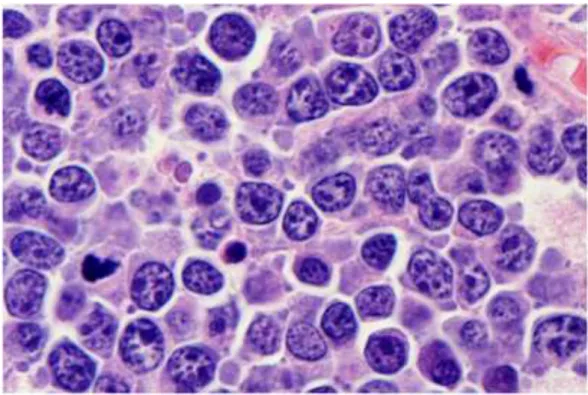 Figura 3 – LB num doente VIH+. As células exibem uma aparência plasmócitoide (H &amp; E, 400x)