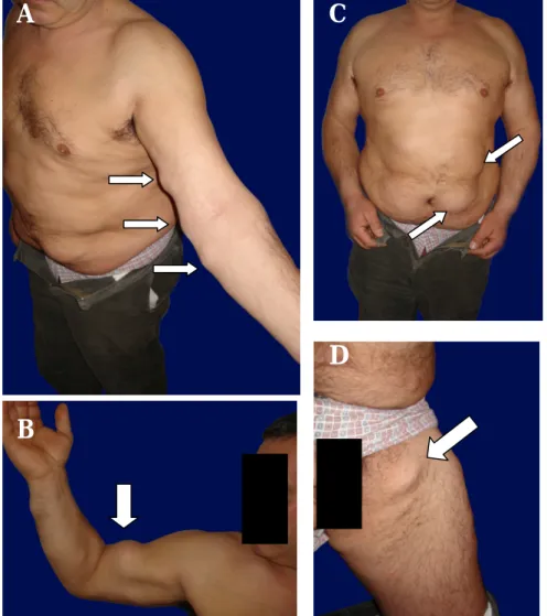 Figura 5 – Fotografias do doente 3: A- Múltiplos lipomas dispersos pelo membro superior esquerdo, envolvendo o  antebraço;  B-  Lipoma  na  região  bicipital  e  aparentemente  intra-muscular  à  palpação;  C-  Múltiplos  lipomas  provocando deformação da 