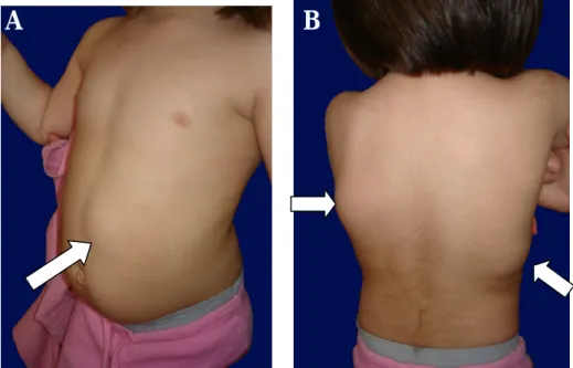 Figura 7 – Fotografias do doente 4: A- Lipoma da parede abdominal, localizado na região paramediana esquerda e  supra-umbilical;  B-  Lipomas  da  região  dorsal,  com  dimensões  acentuadas,  superfície  lisa,  consistência  mole  e  de  contornos mal def