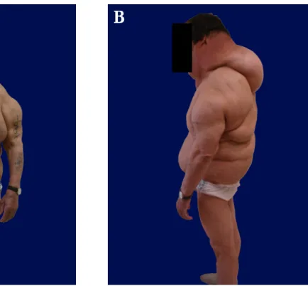 Figura 8 – Fotografias do doente 5: A- Doença de Madelung (vista anterior); B- Doença de Madelung (vista lateral  esquerda); C- Doença de Madelung (vista posterior)