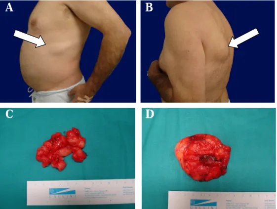 Figura 4 – Fotografias do doente 2: A- Lipoma do hemitórax esquerdo; B- Lipoma infra-escapular esquerdo; C-  Aspecto  cirúrgico  do  lipoma  do  hemitórax  esquerdo  após  excisão;  D-  Aspecto  cirúrgico  do  lipoma  infra-escapular  esquerdo após excisão