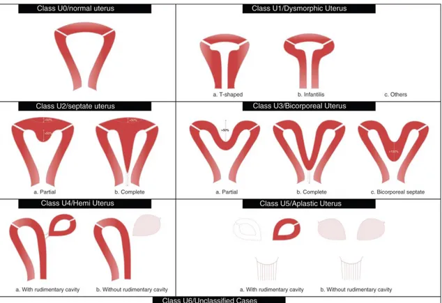 Figura 4 - Representação esquemática da anatomia uterina na classificação sugerida pela ESHRE/ESGE em  2013 (32) 