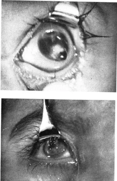 FIGURA  64JIceración  cornea1  (Grado  V).  Ulcera  cornea1  grande  con  bordes  infiltrados  y  cortados  en  sacabocado