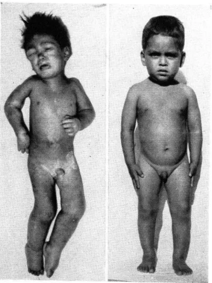 FIG.  5.-Niño  de dos años, ocho meses de edad al ingresar  al hospital  con SPI 