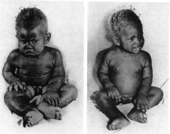 FIG.  l.-Niño  de  trece  meses  de  edad  con  kwashiorkor  “cl&amp;ico”  (sugar  baby),  al  ingresar  al  hospit,aI  (izquierda)  y  después  de  seis  semanas  de  tratamiento  (derecha)
