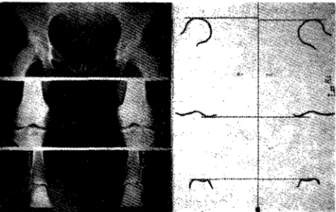 FIG. 1 — Radiografia e esquema  o b t i d o s pela «técnica das três  exposições sucessivas»  ( F a r r i l ) 