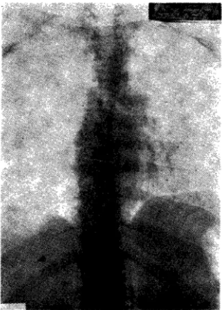 FIG. 6 — Escoliose. 