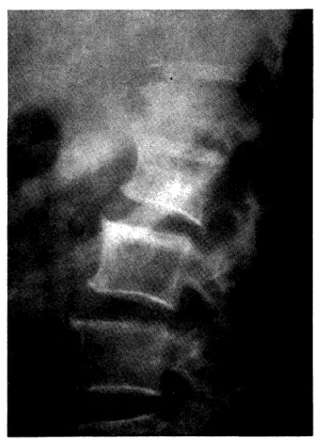 FIG. 11 — Espondiiite  m e l i t o c ó c c i - -ca. Osteofitos de  repa-ração  e n v o l v e n d o o  disco  a l t e r a d o 
