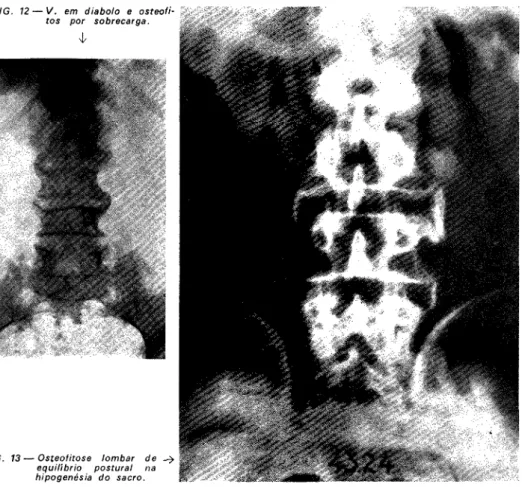 FIG. 12 — V. em diabolo e osteofi- osteofi-tos por sobrecarga. 