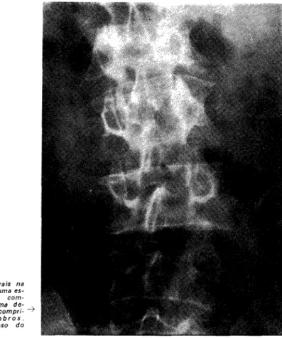 FIG. 16 — Osteofitos  p o s t u r a i s na  c o n c a v i d a d e  d e uma  escoliose  l o m b a r ,  c o m  -pensadora  d e uma  desigualdade no  c o m p r i  -m e n t o dos  -m e -m b r o s 