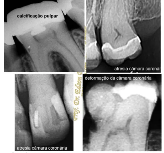 Figura 2 - Câmaras coronárias alteradas - vista radiográfica. 