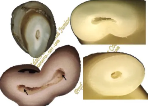 Figura  3  -  Raízes  e  canais  radiculares  em  cortes  transversais.  Setas  mostram as entradas dos canais [bifurcação] em uma raiz