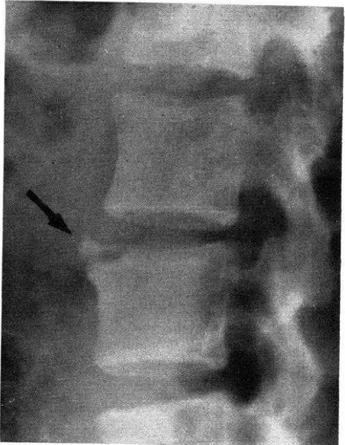 FIG.  1  .-Desprendimiento  del  &amp;ngulo  antero-  superior  del  cuerpo  de una  vértebra  dorsal