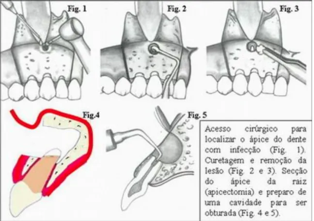 Figura 1 – Procedimento Cirúrgico de uma Cirurgia Periapical. (Palma V., 2010) 