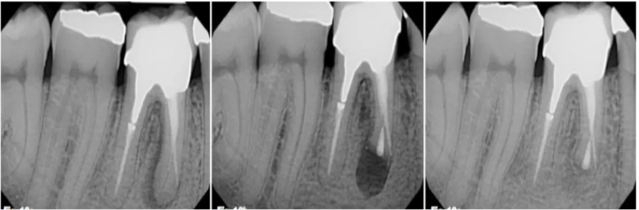 Figura 9 – Imagem de primeiro molar inferior com lesão apical na raiz mesial, em seguida imagem do  mesmo  dente  logo  após  cirurgia  periapical  (apicectomia)  com  obturação  retrógrada  com  cimento  biocerâmico, finalmente a regeneração da mesma lesã