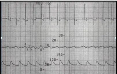 Figura  6.  Electrocardiograma  mostrando  o  traçado  da  pressão  atrial  direita  e  o  traçado  da  pressão arterial no cão – Adaptado de Monnet (2002)