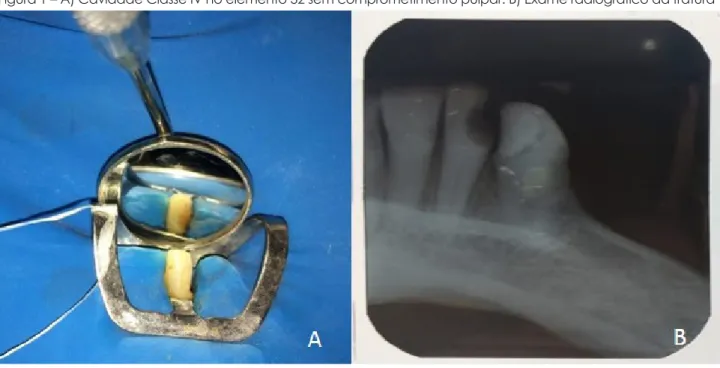 Figura 2 – A) Remoção do tecido hiperplásico. B) Restauração provisória com Cimento de Ionômero de Vidro  Fotoativado
