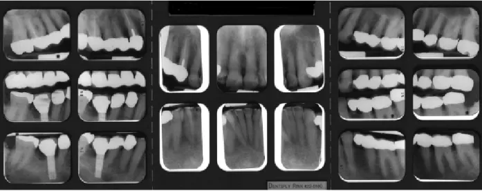 Fig. 4- Série radiográfica pré-tratamento (Rinchuse et al., 2007). 