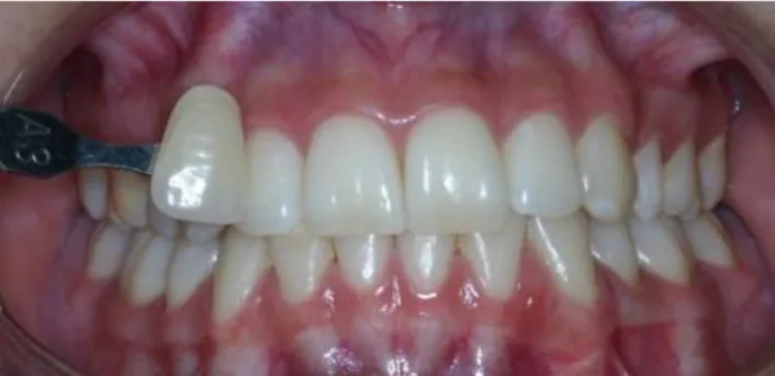 Figura 9 –Antes e Depois de 6 meses do Branqueamento Dentário. 