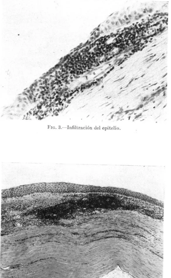 FIG.  S.-Infiltración  del  epitelio. 