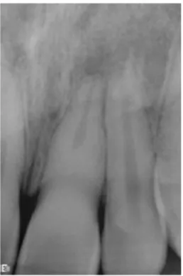 Figura  2:  Radiografia  periapical  de  um  incisivo  central  superior  esquerdo  com  calcificação parcial canalar e lesão apical