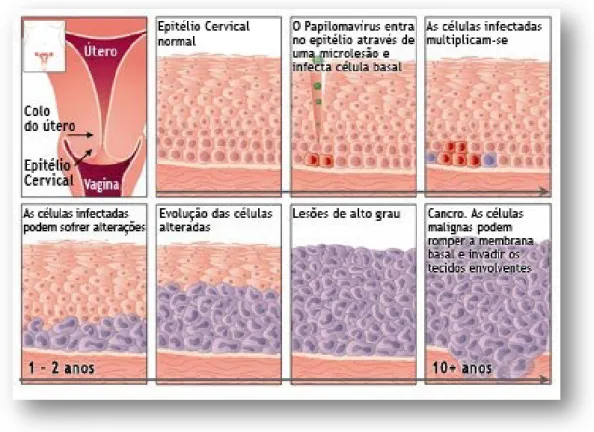 Figura 2 - Progressão do cancro do colo do útero (adaptado de Sanofi Pasteur MSD). 