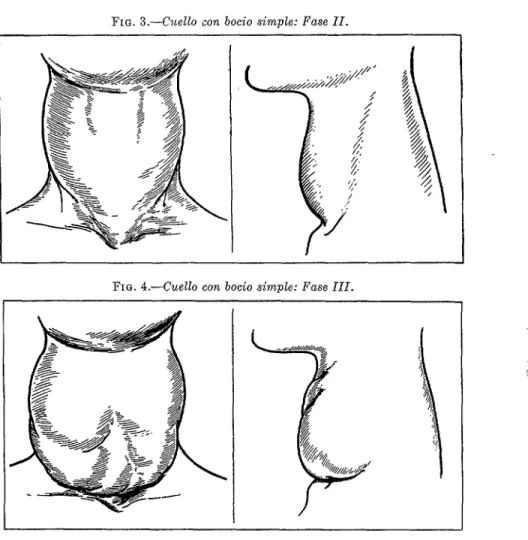 FIG.  4.-Cuello  con  bocio  simple:  Fase  III. 