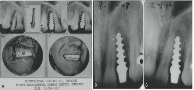 Figura 1 – (A) Primeira extração e colocação imediata de implante endo-ósseo seguido  de restauração dentária