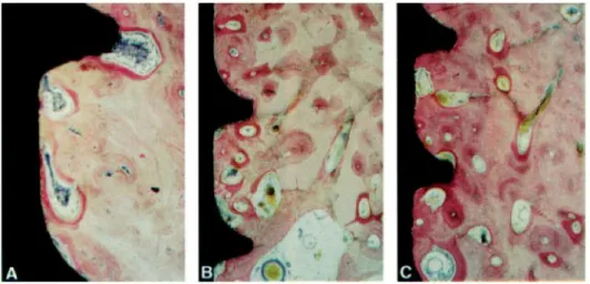 Figura  8  –  Contato  ósseo  secundário.  (A)  Implante  submerso  após  colocação,  (B)  3  meses  após  a  colocação  e  (C)  12  meses  após  colocação  em  carga  convencional  dos  implantes (Cochran, D