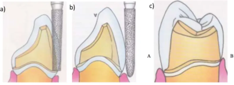 Figura  1:  Terminações  possíveis  para  a  região  cervical  de  um  preparo  para  faceta  dentária:  a)  Ombro  (ou  degrau  90  graus  (º)),  b)  Degrau  com  chanfro  (ou  bisel),  c)  Preparo  dentário  com  dois  tipos  de  terminação  cervical  – 