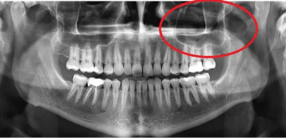Figura 2: Radiografia da localização do seio maxilar (fonte: bilderbeste.com). 