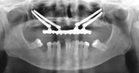 Figura 3: Implantes zigomáticos, com ancoragem no osso zigomático (fonte: implantemaster.com) 