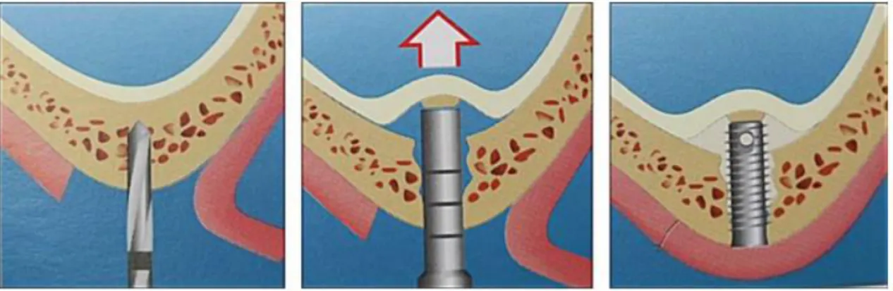 Figura 4: Técnica de Summers (Abaszhiey, 2009, p.24).