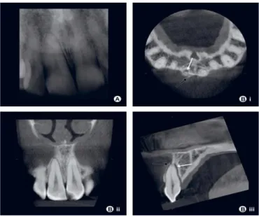 Figura 9: A) radiografia periapical de um dente 1.1 com uma luxação. (bi) corte axial CBCT, (bii) corte  coronal CBCT, (biii) corte sagital CBCT do mesmo dente 1.1