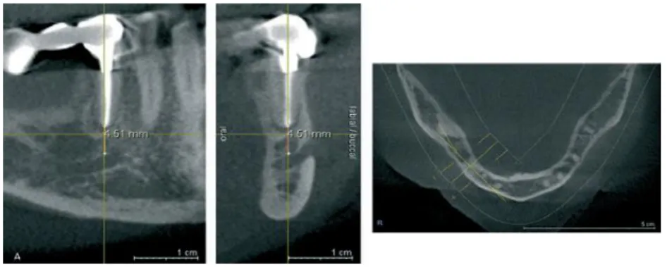 Figura 12 Exemplo de um caso de imagens 3-D foi importante para o planeamento de uma apicectomia