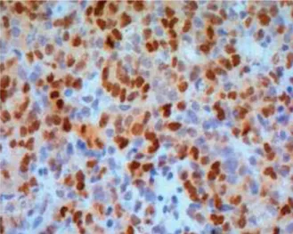 Figura 8. Evidenciação de imunomarcação específica para topoisomerase IIα em tecido humano  (adaptado de Cheng, 2012) 