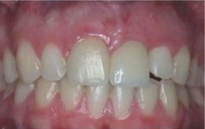 Figura 5: Tipos de sondas periodontais (Massimo Mazza)Figura 4: Biotipo gengival grosso (Caube et al., 2009)
